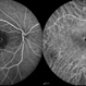 Chronic Central Serous Chorioretinopathy Chronic Central Serous Chorioretinopathy